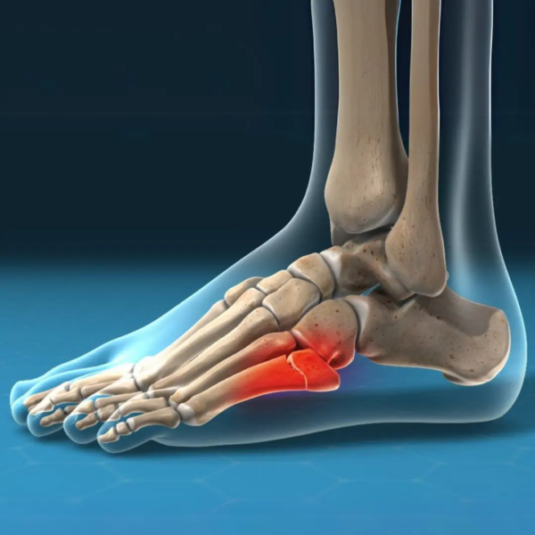 Fracturas por estrés en el pie en tenis: el dolor que aparece “poco a poco” pero puede pararte meses